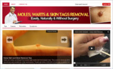 Thumbnail Moles, Warts & Skin Tags Blog - Blog with PLR License